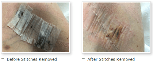Before and after stitches removed